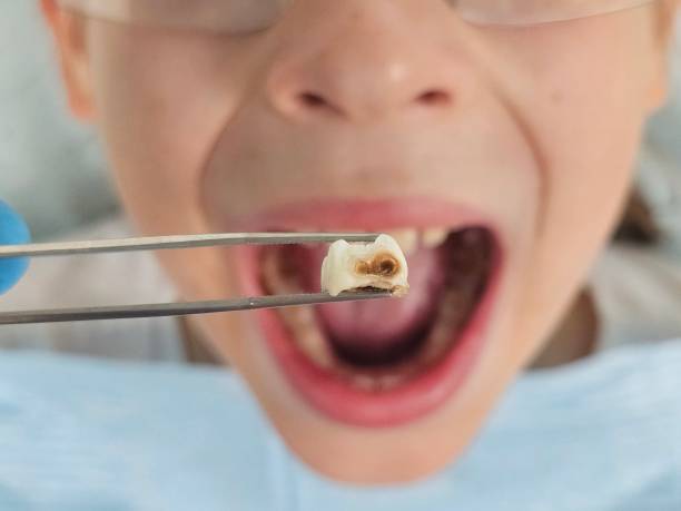 Best Dental Abscess Treatment in Crow Agency, MT