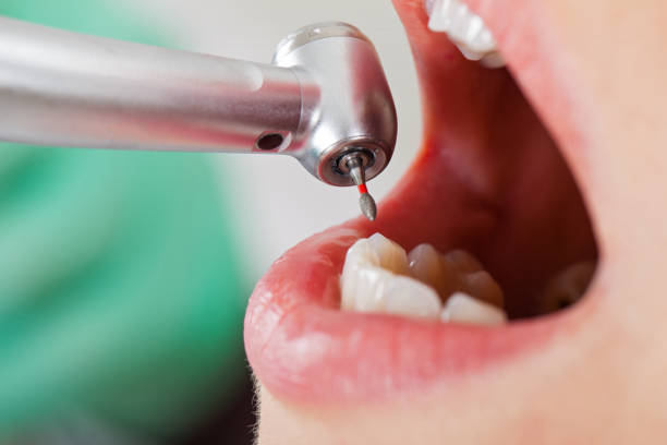 Best Broken or Chipped Tooth Repair in Crow Agency, MT